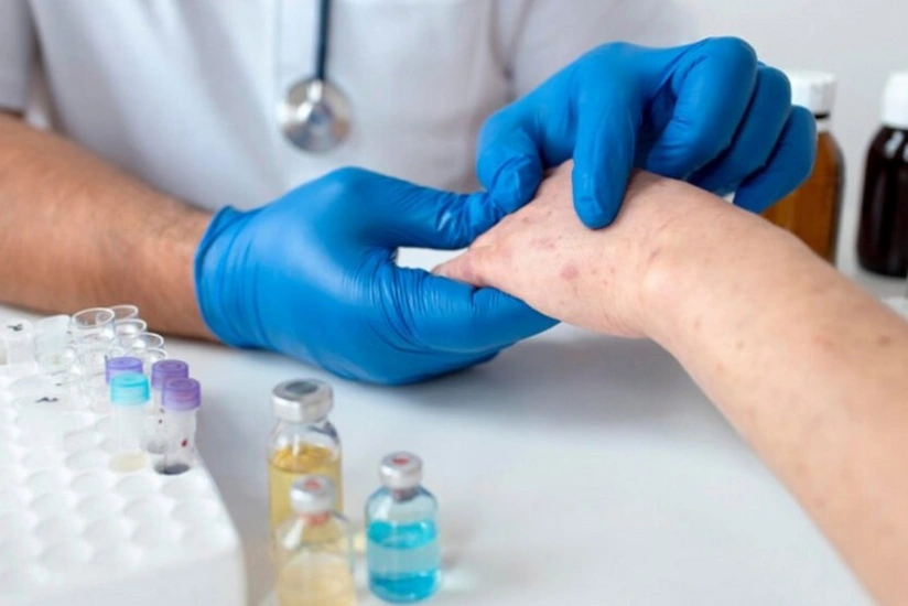 В Армении выросло число случаев заражения корью