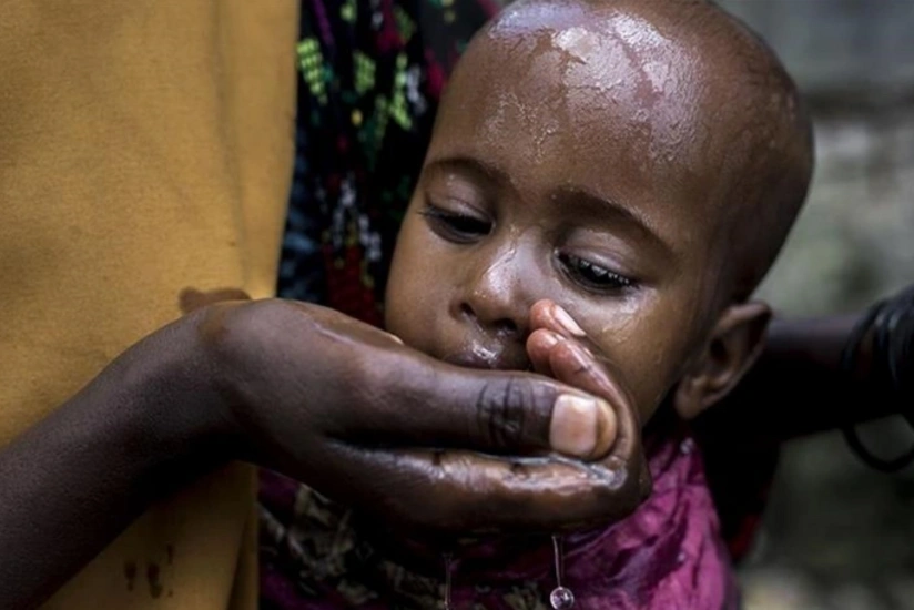 Sudanda vəba epidemiyası qurbanlarının sayı 1 258 nəfərə çatıb