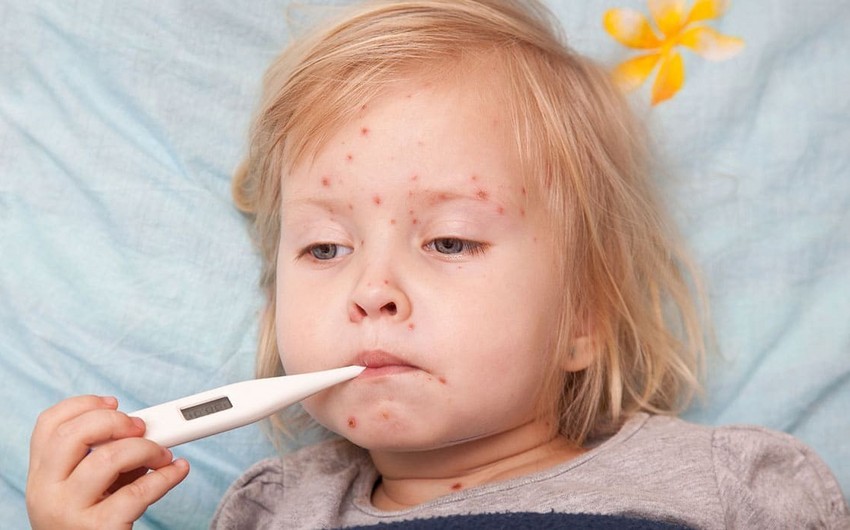 Gürcüstanda qızılca epidemiya həddinə çatıb, əhali pulsuz peyvənd olunacaq