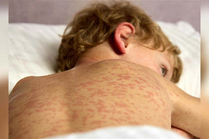 Ermənistanda son bir həftə ərzində daha 8 nəfər qızılcaya yoluxub