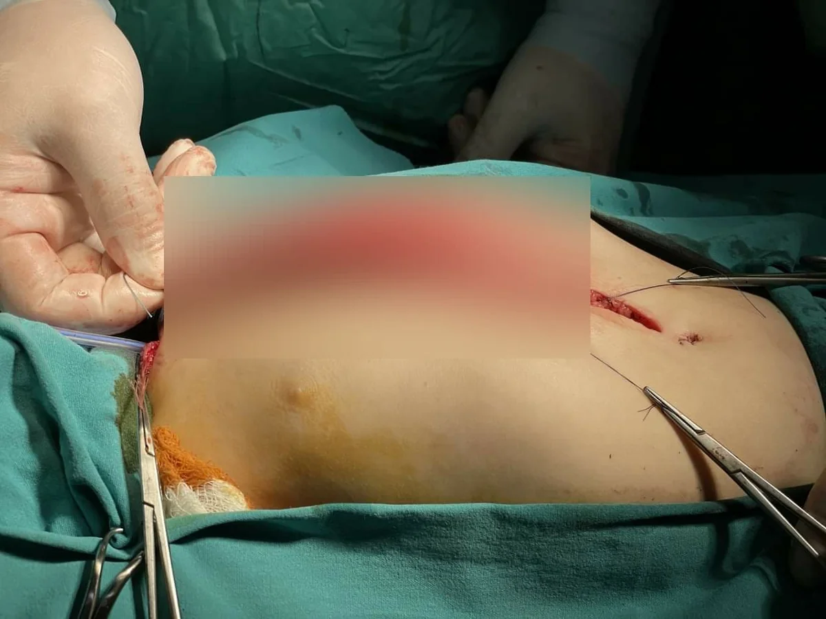 Esophageal replacement surgery performed in Azerbaijan for first time
