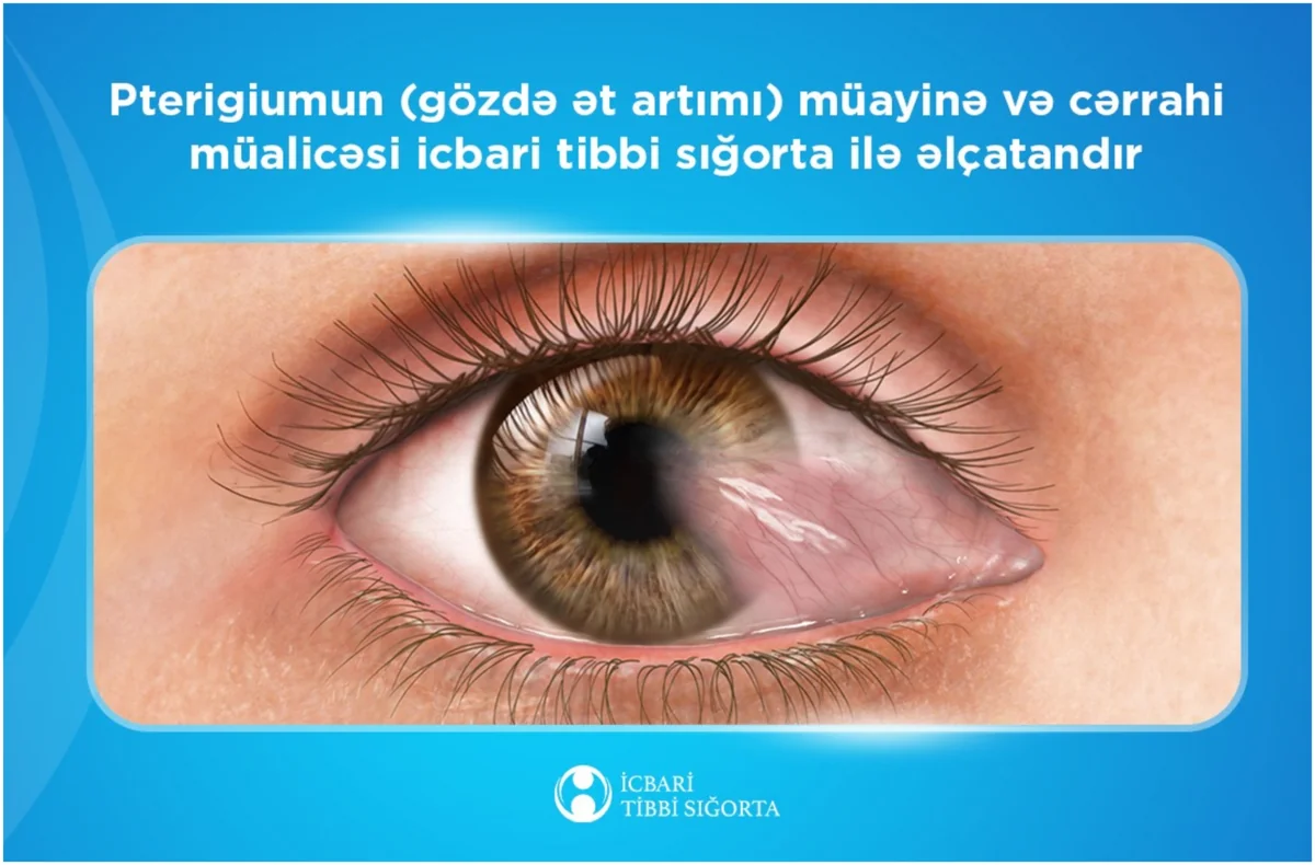 Ötən il icbari tibbi sığorta ilə gözdə ət artığının götürülməsi üçün 2192 əməliyyat edilib