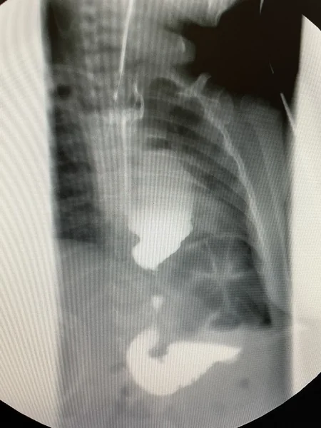 Esophageal replacement surgery performed in Azerbaijan for first time