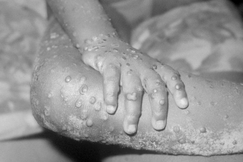 ÜST: Yayda “meymun çiçəyi” xəstəliyinin yayılma təhlükəsi var