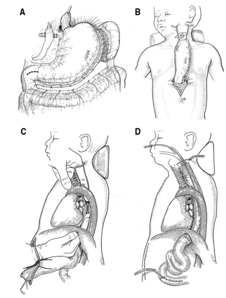 Esophageal replacement surgery performed in Azerbaijan for first time