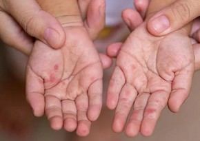 В Монголии число случаев заражения корью превысило 6 тыс.