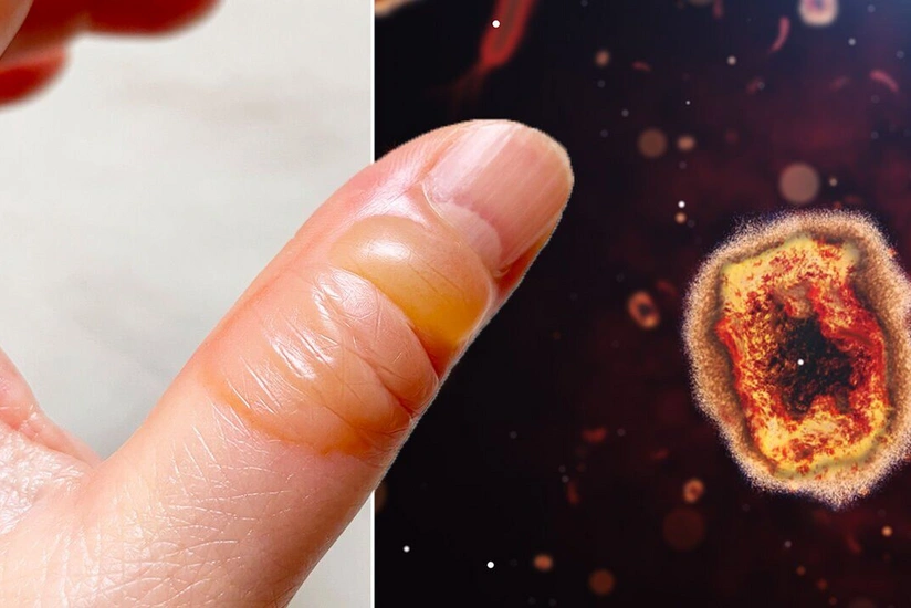 Gürcüstanda meymunçiçəyinə yoluxma ilə bağlı şübhəli hallar aşkarlanıb