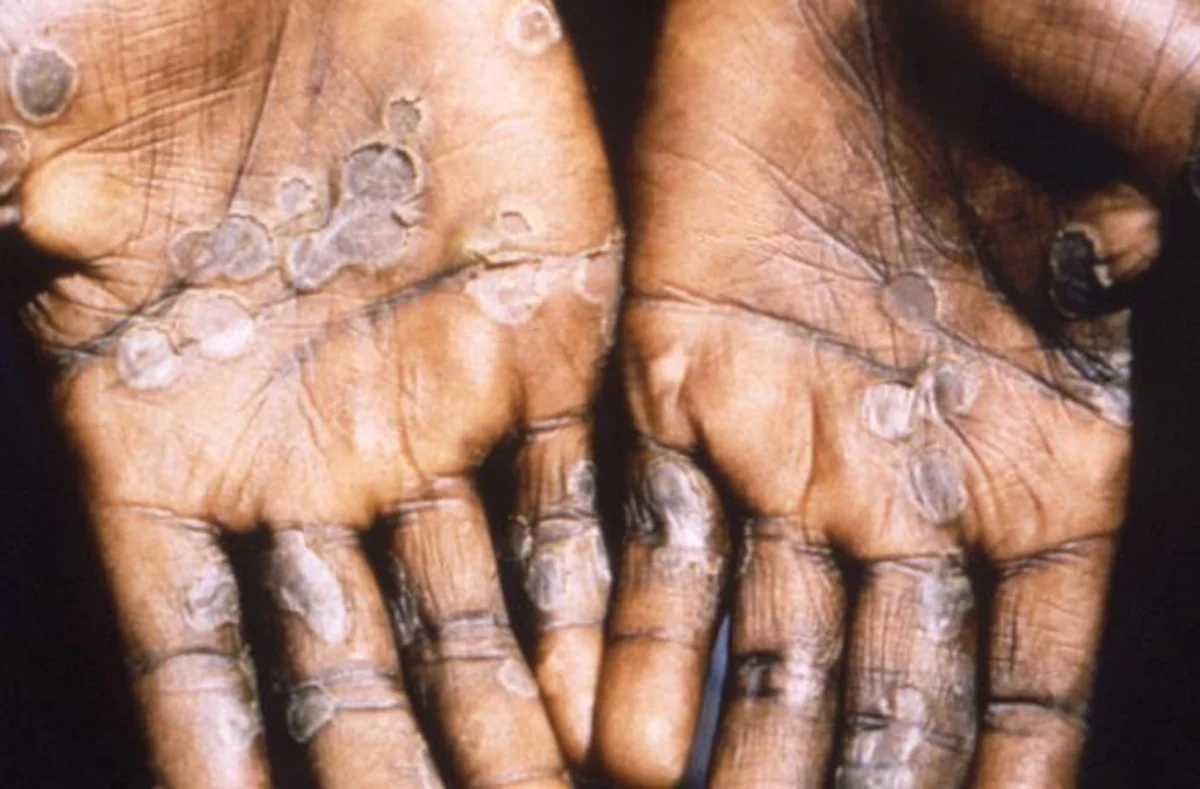 Ireland confirms its first monkeypox case