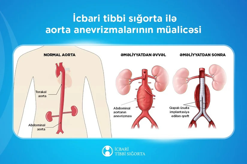 Keçən il icbari tibbi sığorta ilə aorta anevrizmalarının protezləşdirilməsi ilə bağlı 256 əməliyyat icra olunub