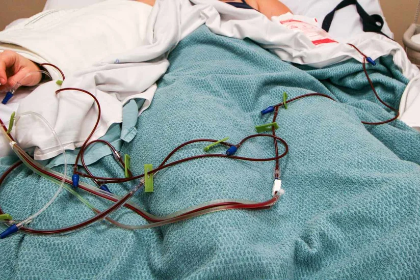 Sümük iliyi transplantasiyası cərrahi müdaxilə olmadan həyata keçiriləcək