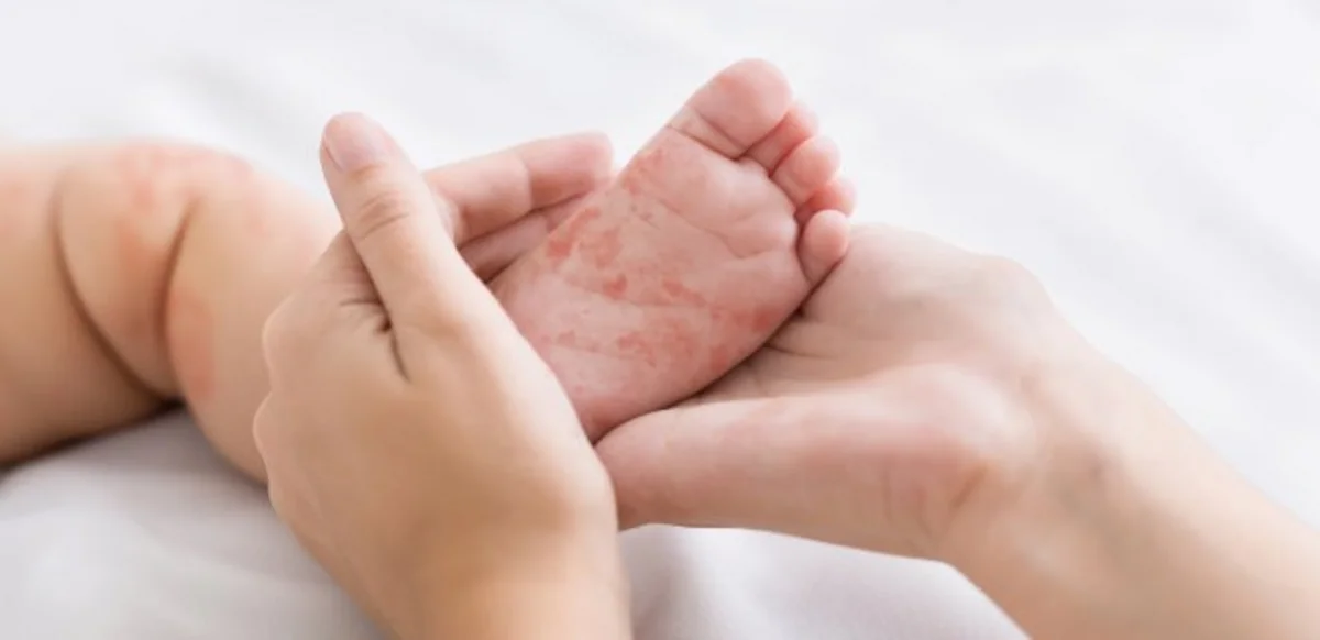 Bruising on feet could be a sign of coronavirus, doctors claim