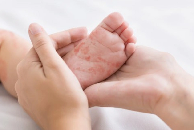 Bruising on feet could be a sign of coronavirus, doctors claim