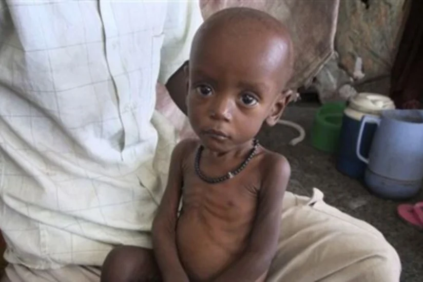 İnkişaf etməkdə olan ölkələrdə uşaq ölümü halları azalmaqdadır