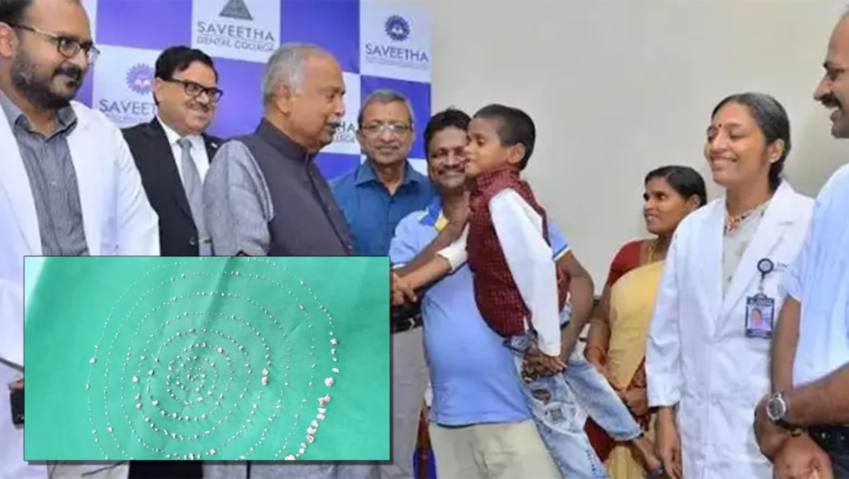 Hindistanda bir uşaqdan 526 diş çıxarılıb