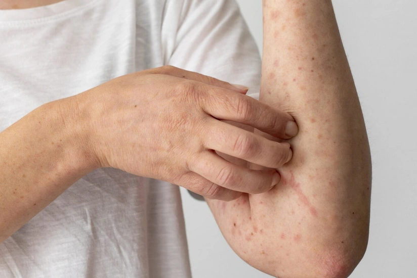 Monqolustanda bütün uşaqlar peyvənd olunacaqlar