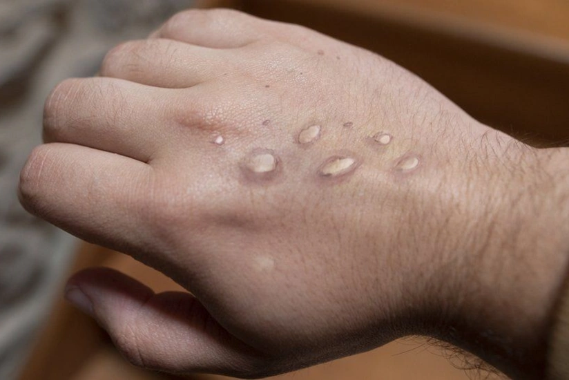 Rusiyada meymunçiçəyinə ilk yoluxma qeydə alınıb