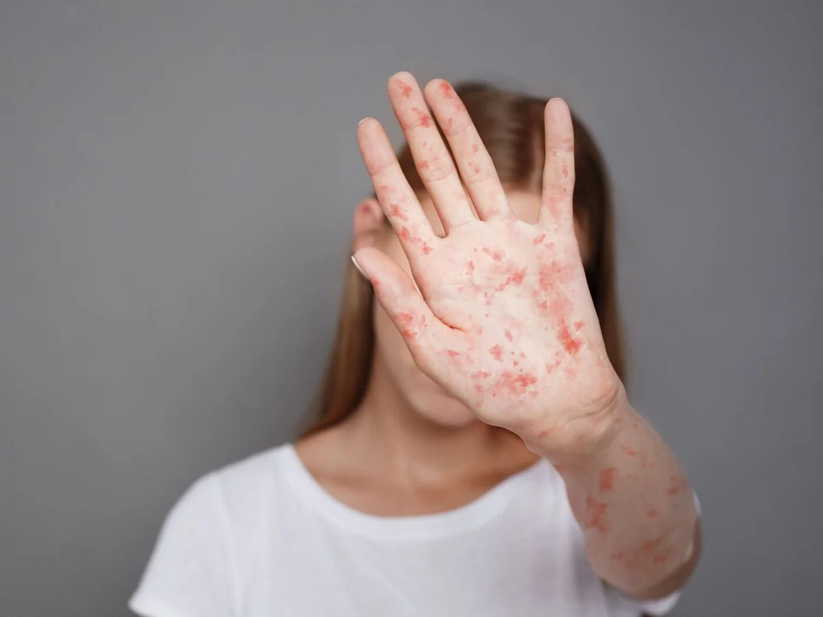 Azerbaijan records 24 cases of measles this year
