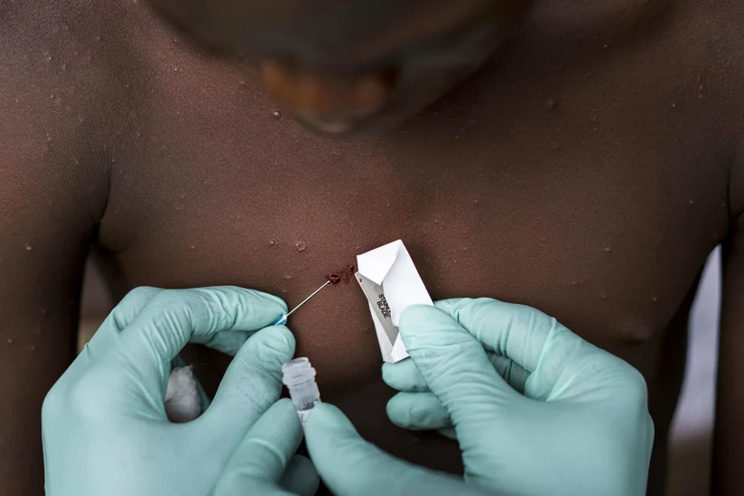 ВОЗ заявил о 37 случаях оспы обезьян в мире