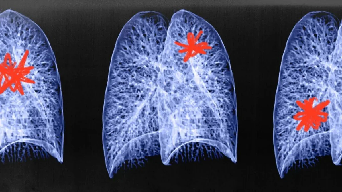 UK artificial intelligence tool can accurately identify cancer