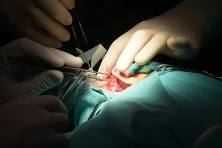 ATU-nun Tədris Cərrahiyyə Klinikasında koxlear implant əməliyyatları keçirilib