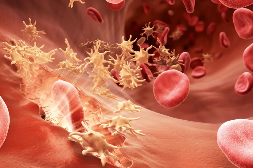 Azərbaycanda hemofiliya xəstələrinin sayı açıqlanıb