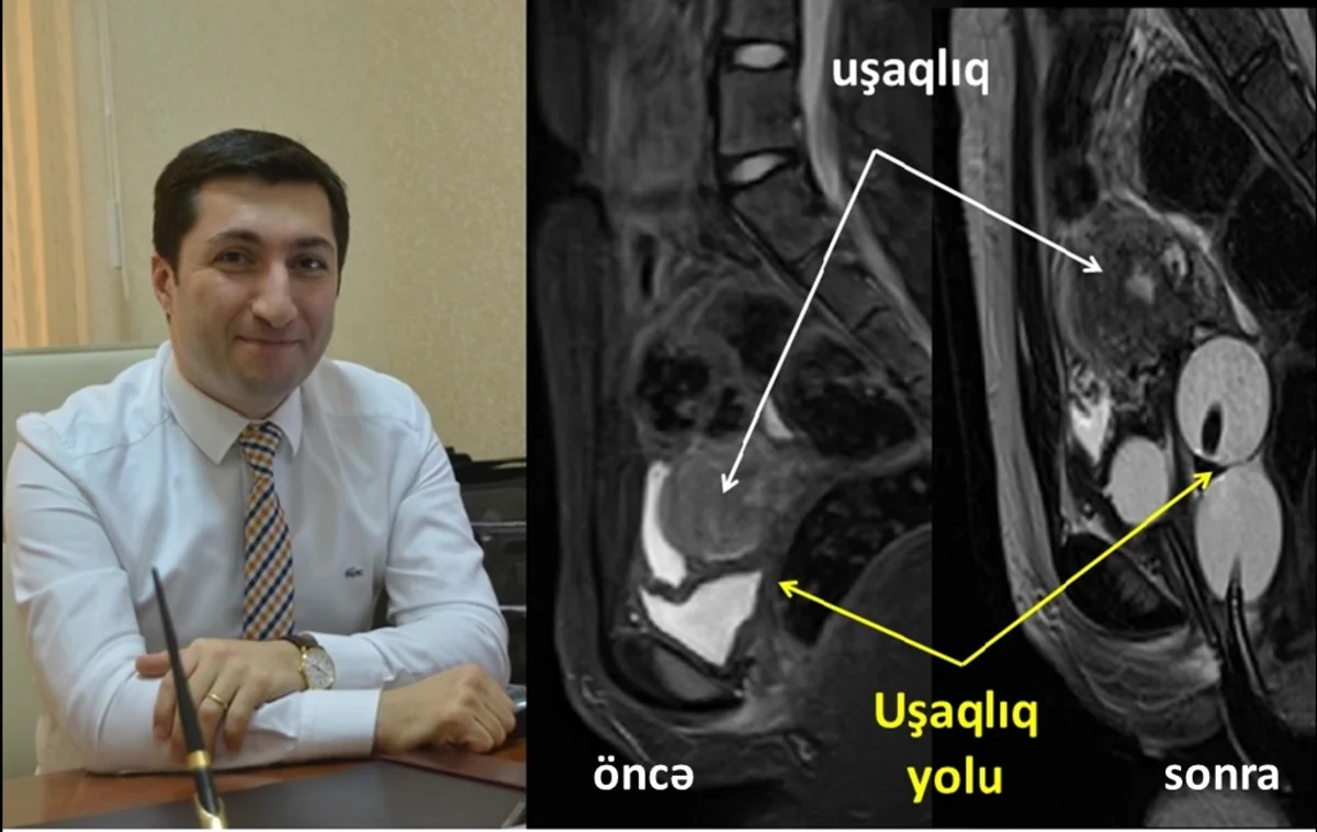 Azərbaycanda 14 yaşlı qız üzərində unikal tibbi əməliyyat keçirilib