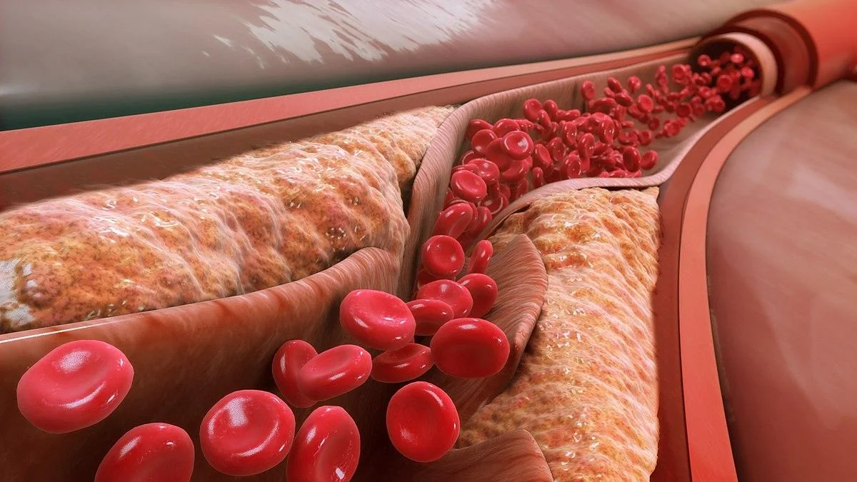 Signs of high cholesterol levels revealed