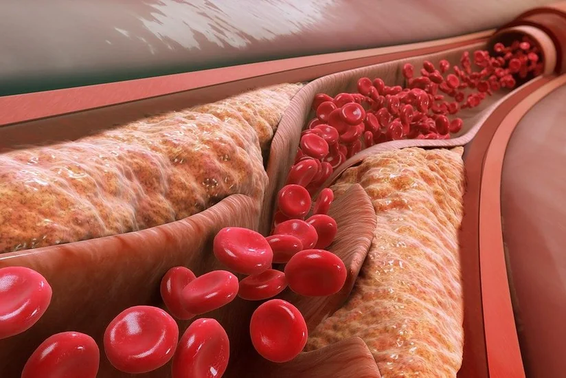 Signs of high cholesterol levels revealed