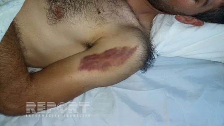 Tərtərdə bir necə nəfərin xəsarət alması ilə nəticələnən kütləvi dava baş verib - FOTO