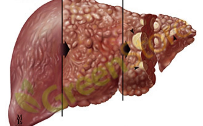 ​Hepatit B qaraciyər xərçənginə yol açır
