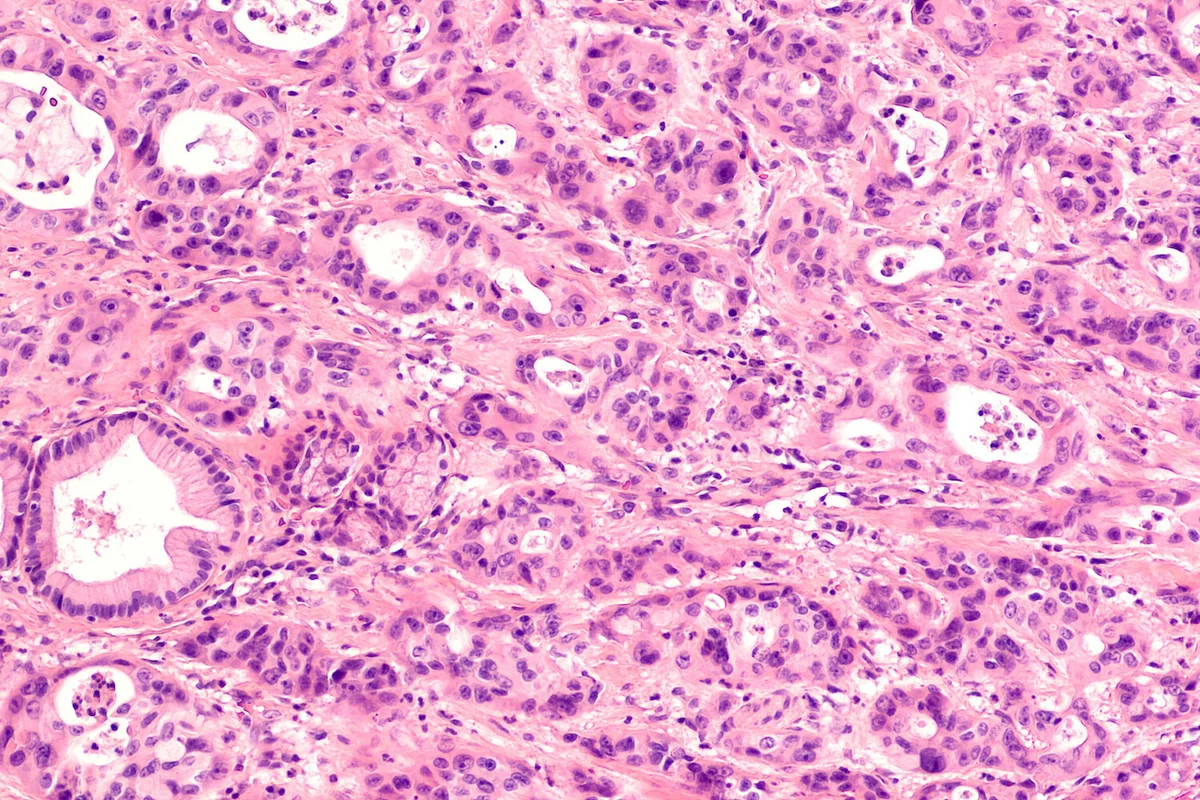 Researchers say two vitamins provoke cancer