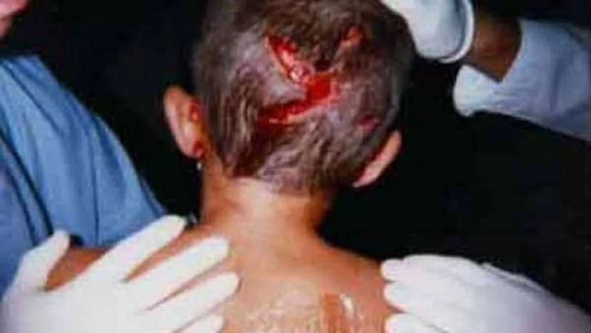 Salyanda 11 yaşlı uşağın baş nahiyəsindən it dişləyib