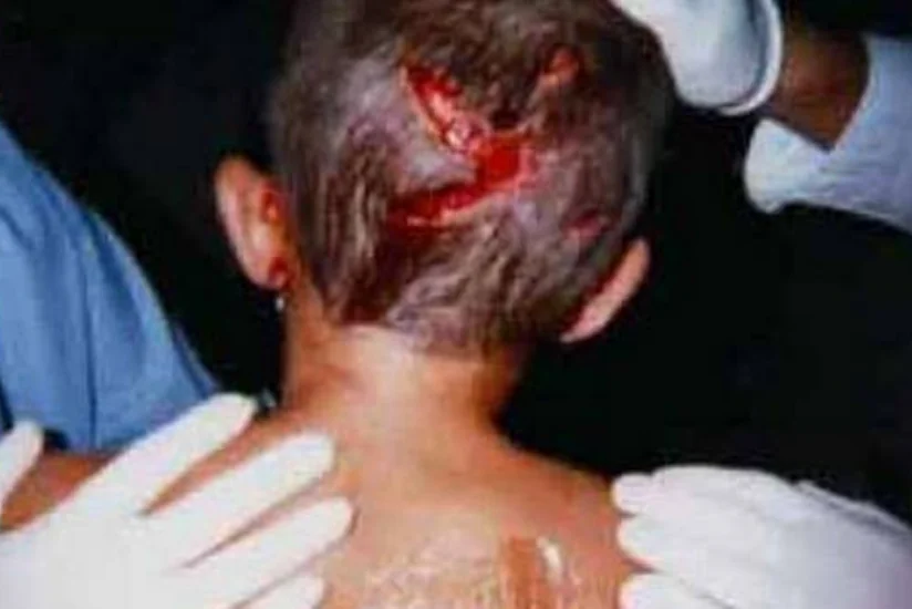 Salyanda 11 yaşlı uşağın baş nahiyəsindən it dişləyib