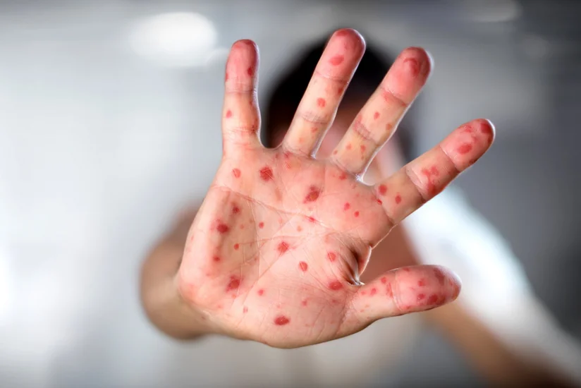 В Армении число заразившихся корью возросло до 29