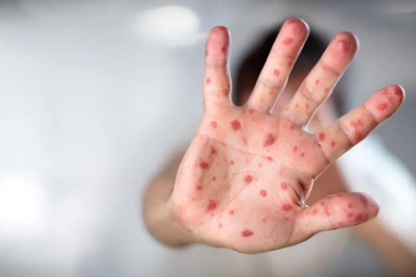 Son bir ayda Zaqatalada 64 nəfər qızılcaya yoluxub